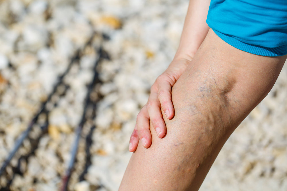 Best Tools for Varicose Veins: Top Picks for Speedy Recovery and Pain Relief